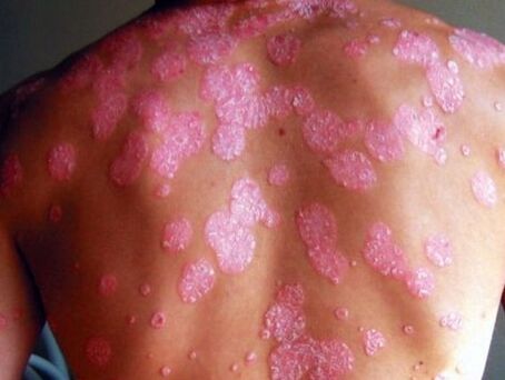 Psoriatická choroba